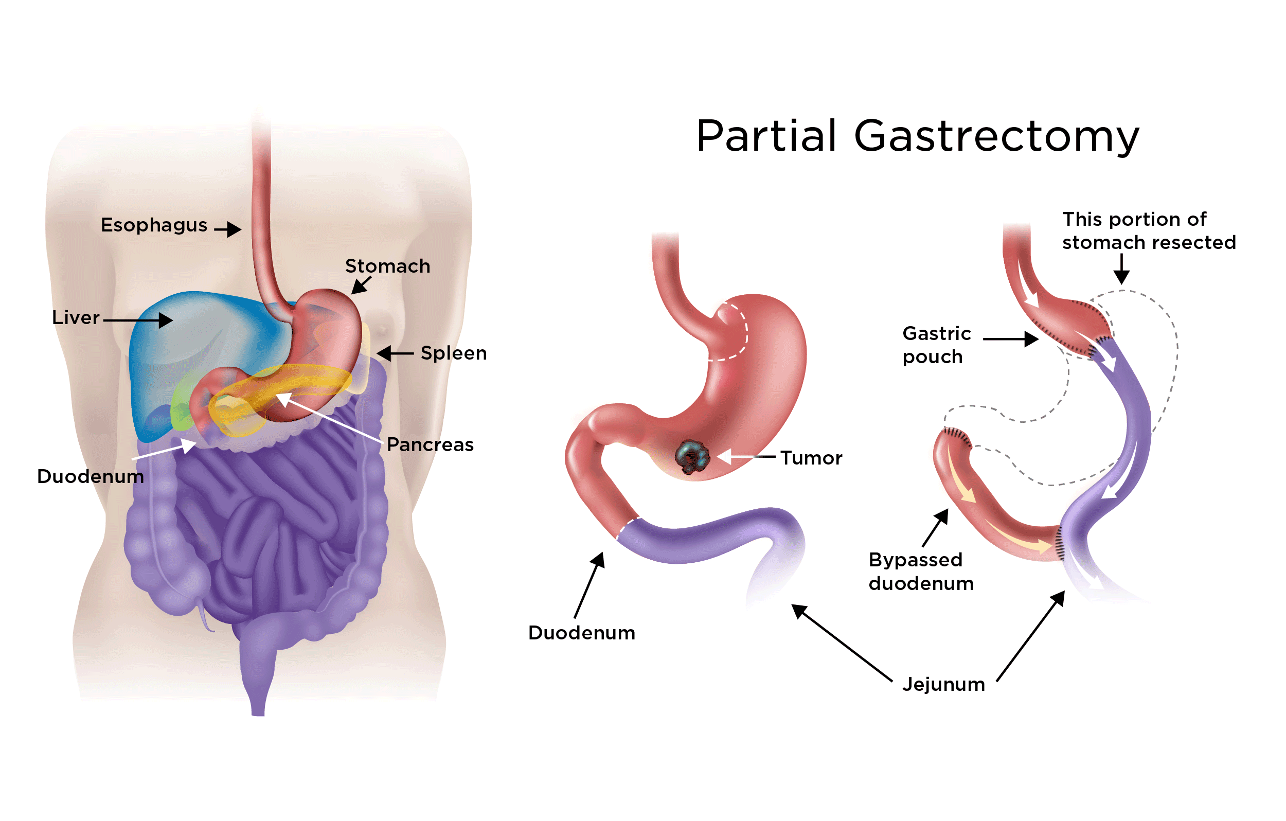 Gastric Cancer Treatment My Doctor Online