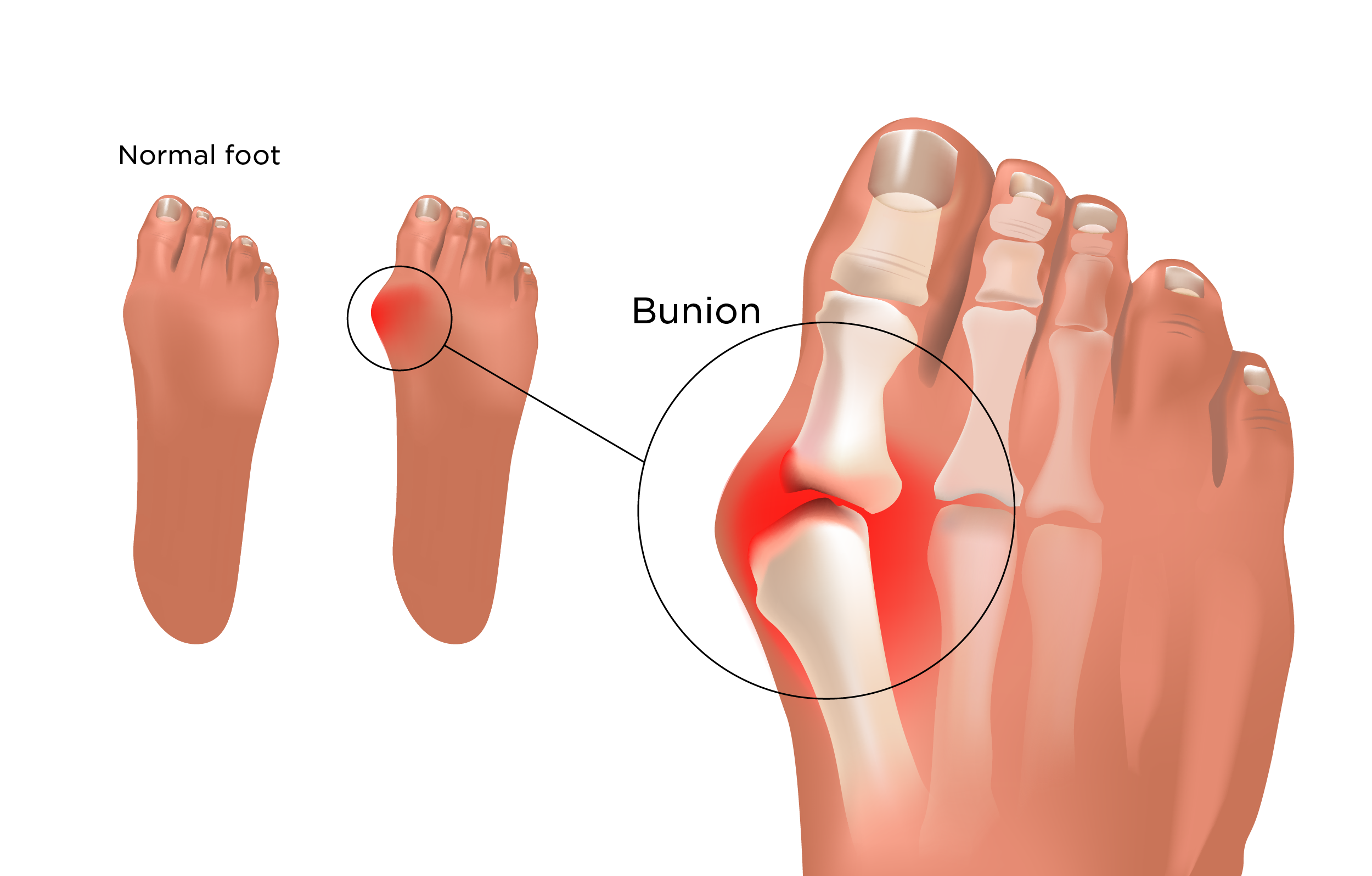 Bunions Bunions