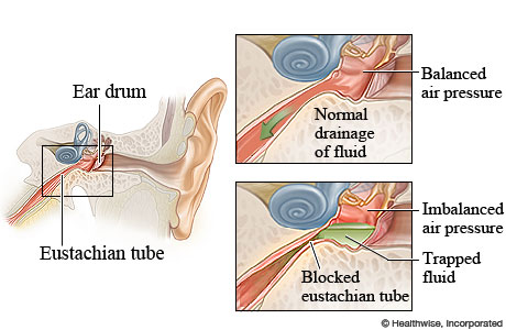Causes, Symptoms, and Treatments of Fluid in the Ear