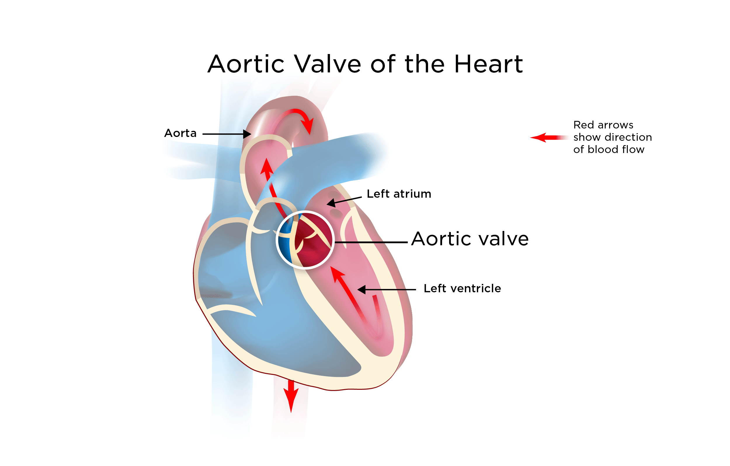 Aortic Heart Valve Disorders