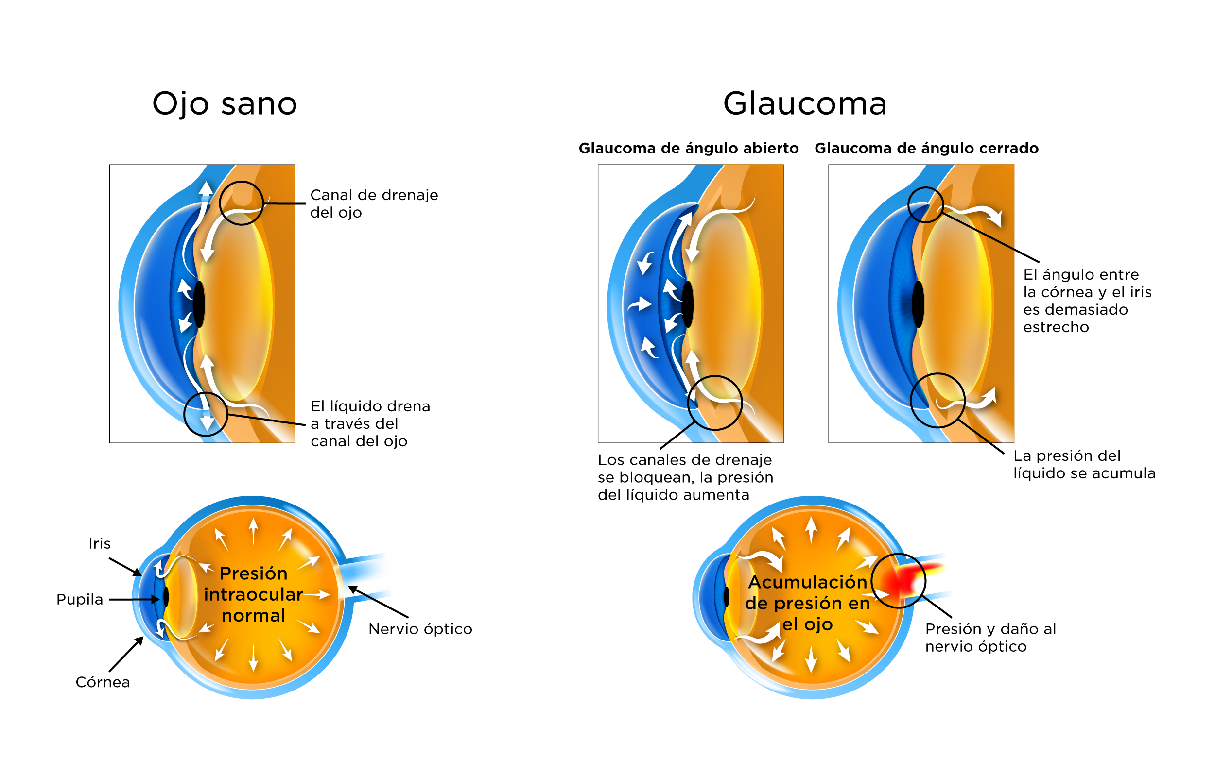 glaucoma agudo de ángulo cerrado