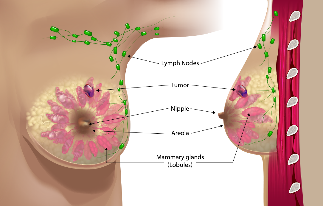 All you need to know about breast biopsies