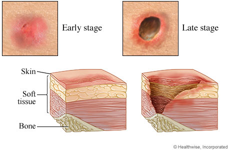 Bedsores (Pressure Ulcers) Condition, Treatments and Pictures for