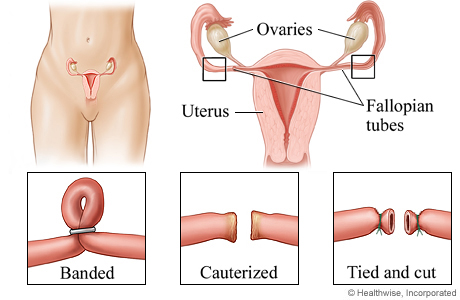 Tubal Ligation: Procedure, Recovery & Side Effects