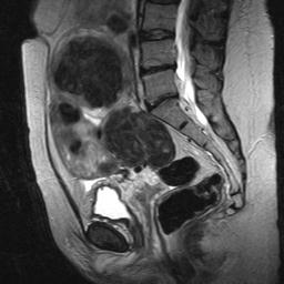 Impending fibroid expulsion on MRI after uterine fibroid embolization -  ScienceDirect