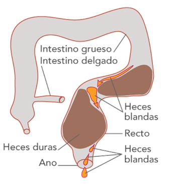 Incontinencia intestinal en los niños