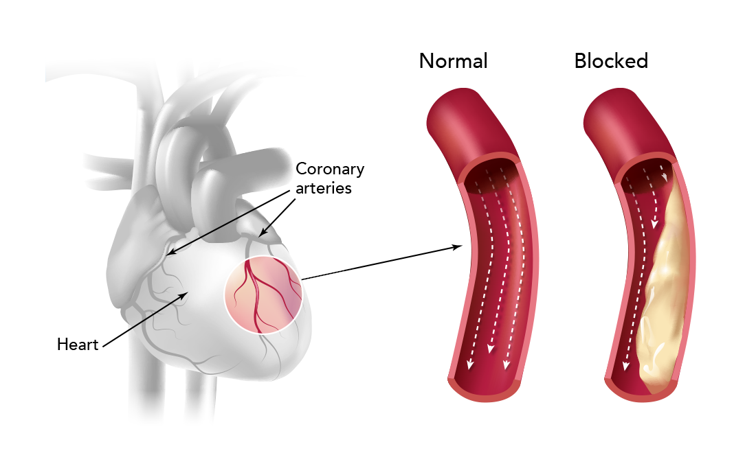 coronary artery disease causes