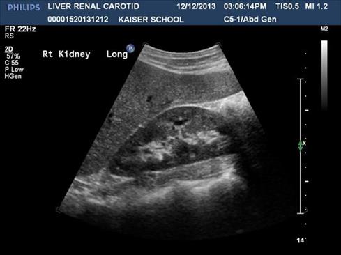 kidney ultrasound images abnormal