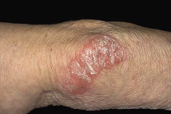 Dermnet pikkelysömör láb képeket Psoriasis dermnet