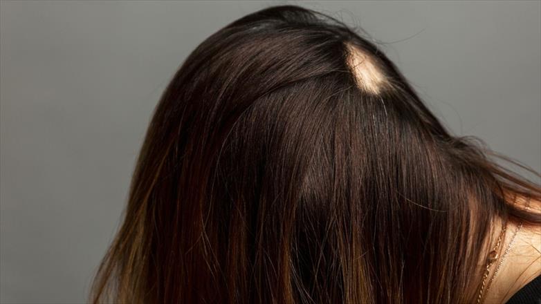 What is Alopecia Areata? Dermatologist Explains this Hair Loss Condition