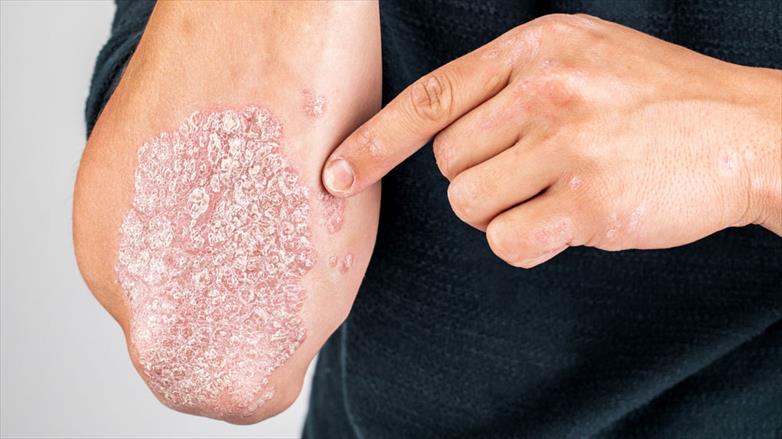 What Is Psoriasis Dermatologist Explains Types Treatments How To Cope