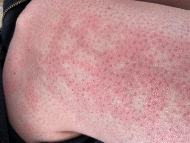 Pad rash: Appearance, causes, treatment, and more