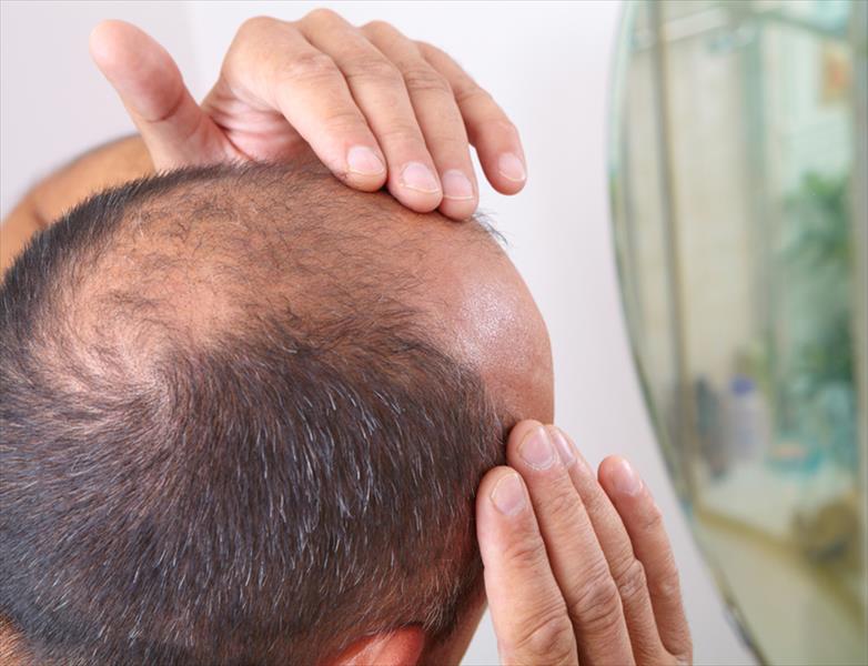 Hair Loss: What You Need to Know