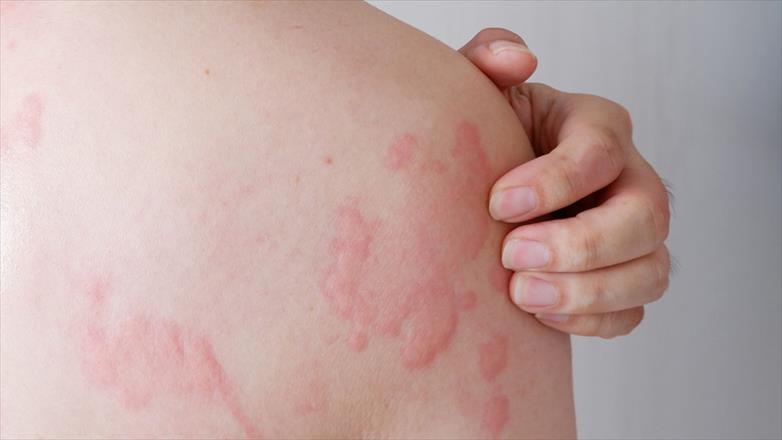 Hives: Causes, Symptoms and Treatments