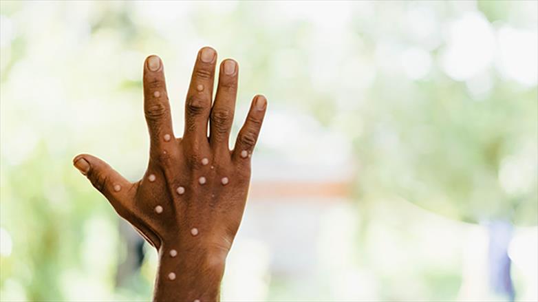 What You Need to Know About Monkeypox