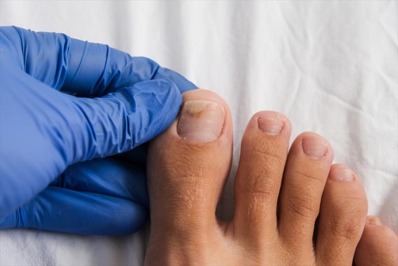 Antifungal For Nail Fungus May Be Safer Than Originally Thought