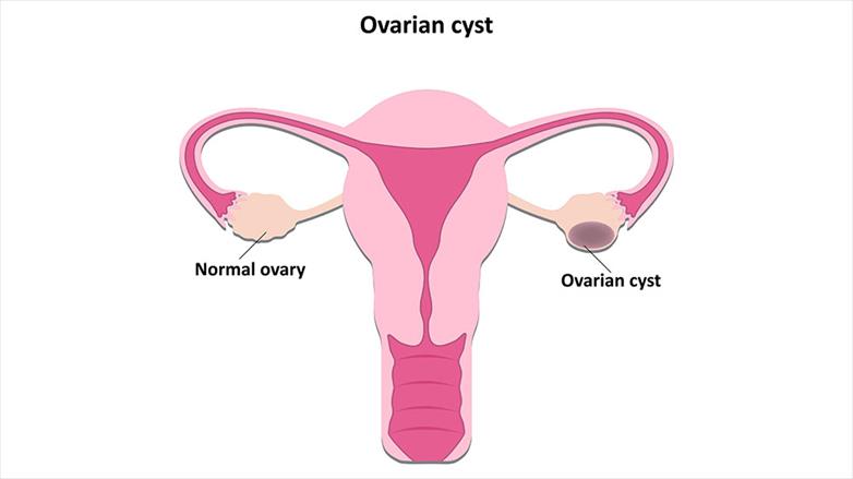 Hemorrhagic Ovarian Cysts: When to Worry about Ovarian Cysts and Ruptures
