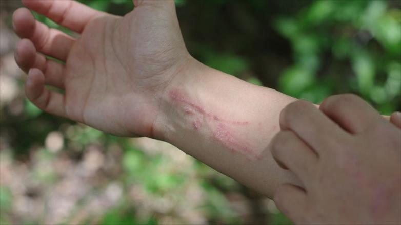 Don't be rash: tidbits about Lyme disease, poison ivy, and sunburn