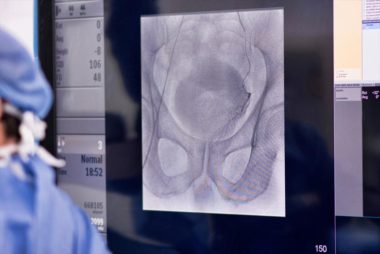 Prostate Artery Embolization: An Innovative Treatment for BPH