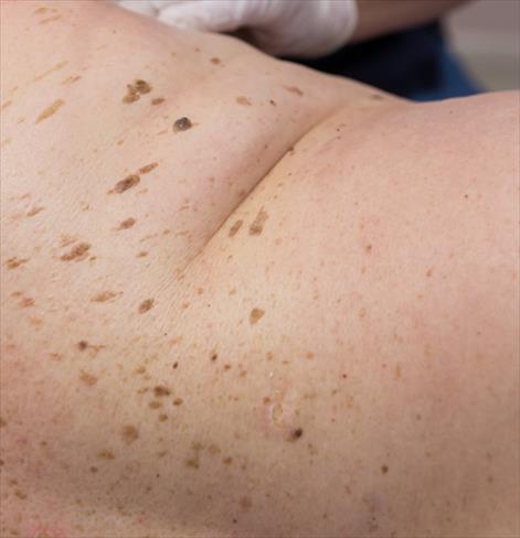 Seborrheic Keratoses: What to Know about these Benign Skin Growths