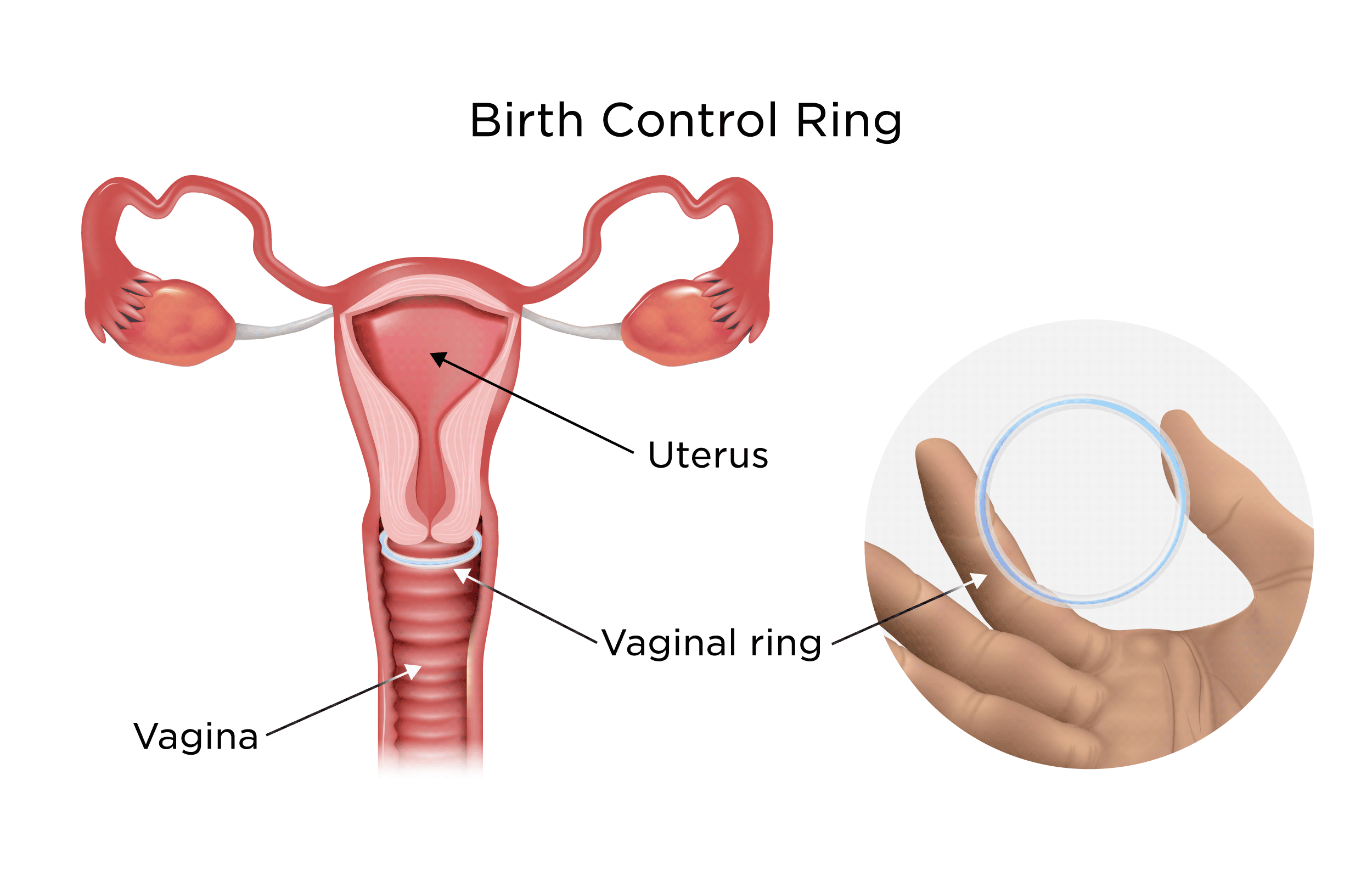 Vaginal Ring For Birth Control: Effectiveness & Side Effects