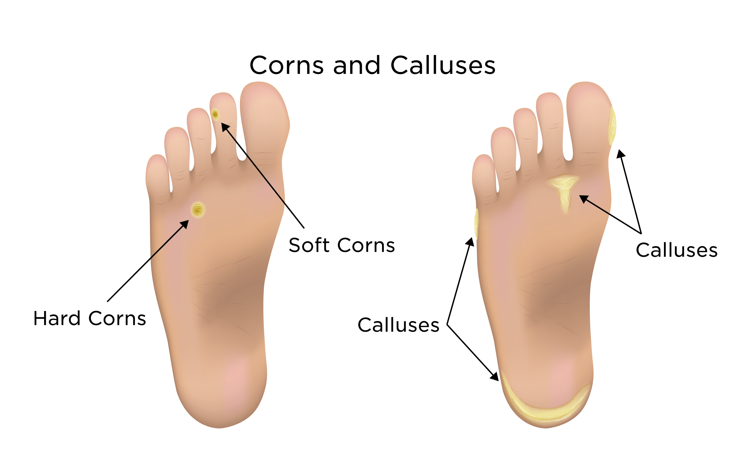 Callouses and Corns