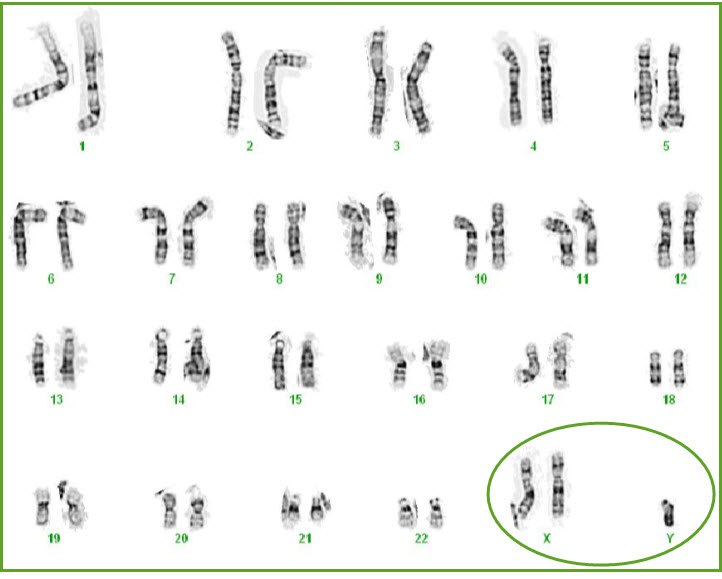 Dna X Chromosome 48 Xxyy Syndrome Is A Chromosomal Condition That | Hot ...