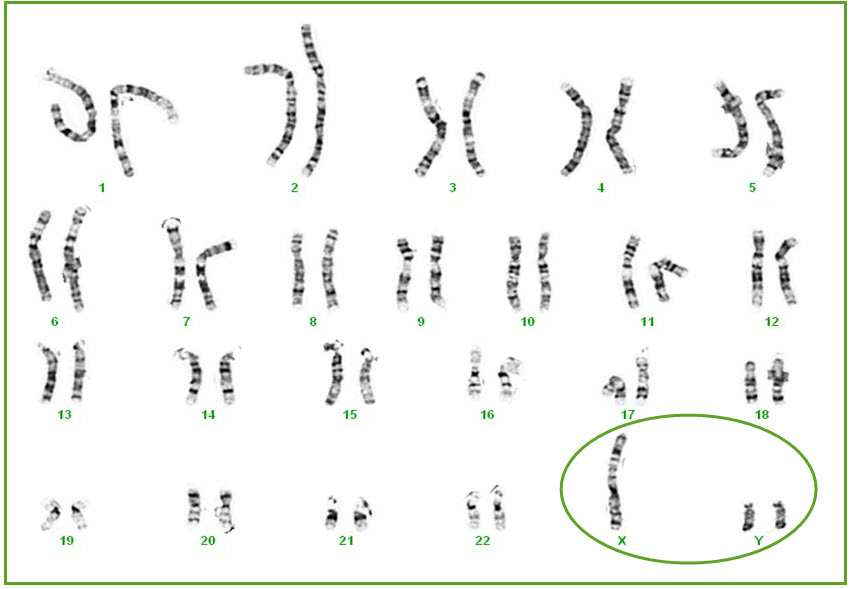 xyy syndrome karyotype