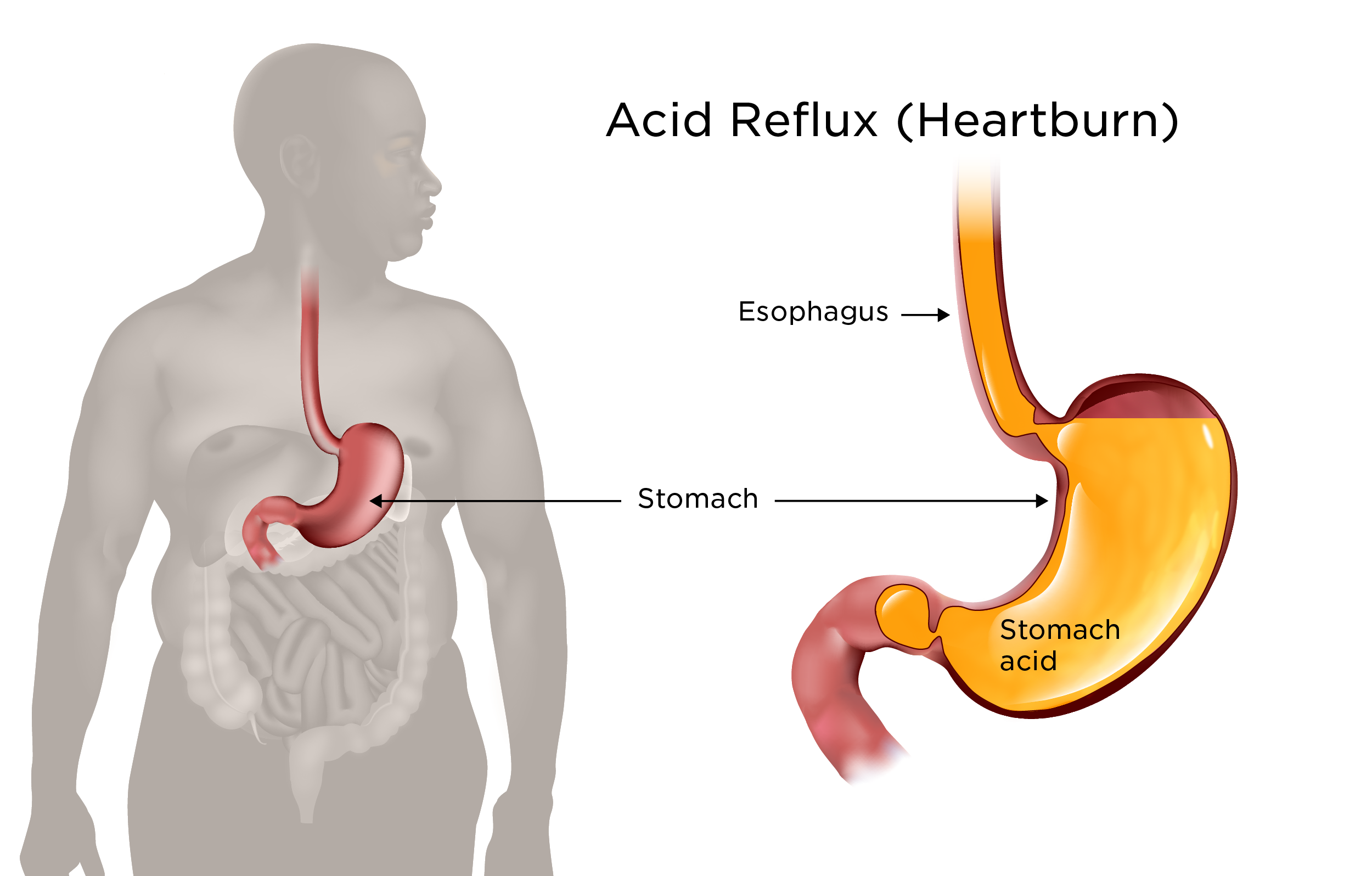 Possible Complications and Side Effects of Weight Loss Surgery | My Doctor  Online