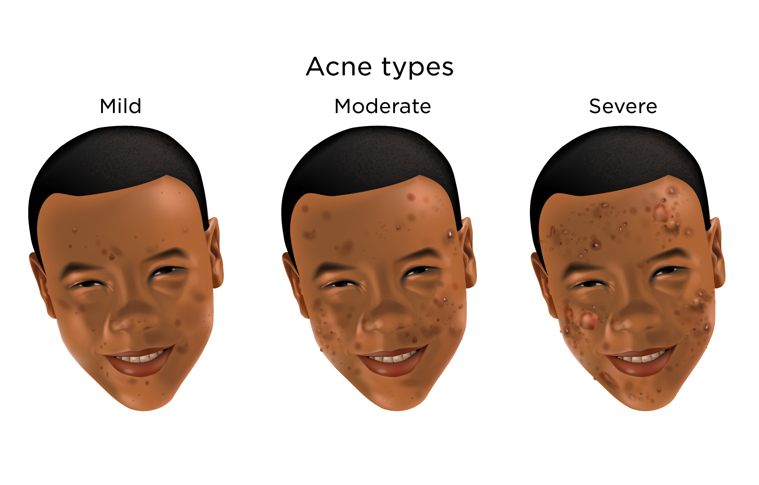 Mild Acne My Doctor Online