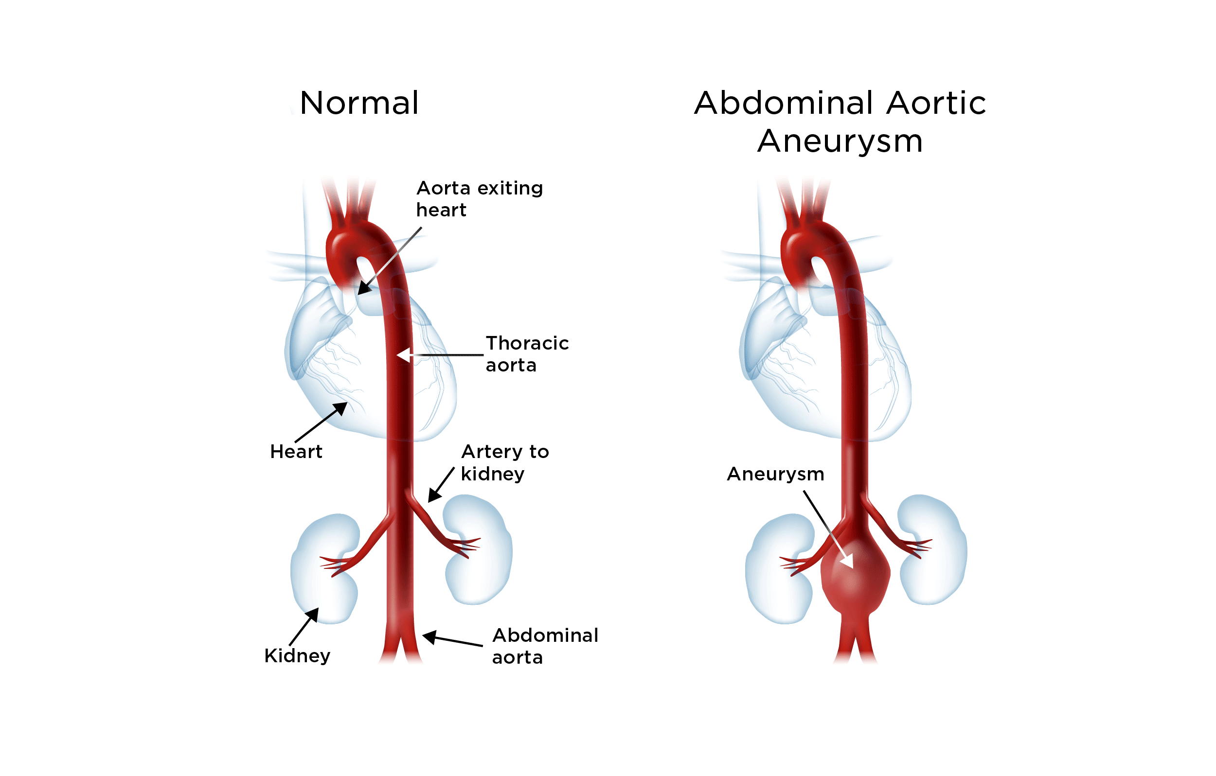 ascending thoracic aortic aneurysm