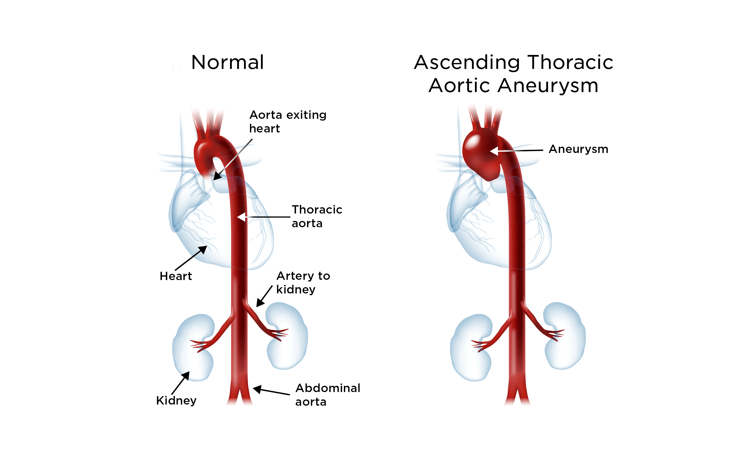 Pda With Ascending Aorta Dilatation Chest X Ray