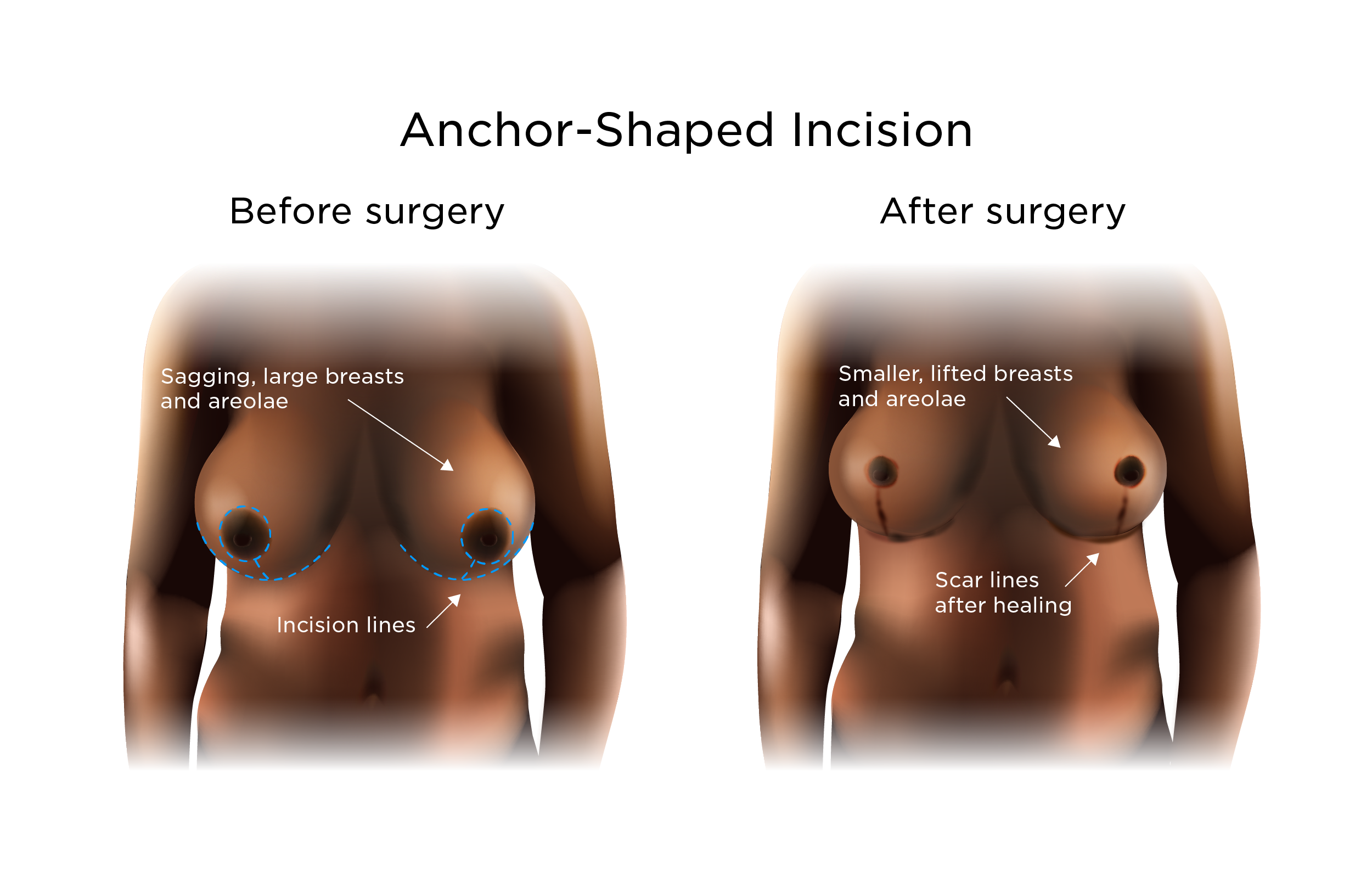 Breast Reduction Surgery | My Doctor Online