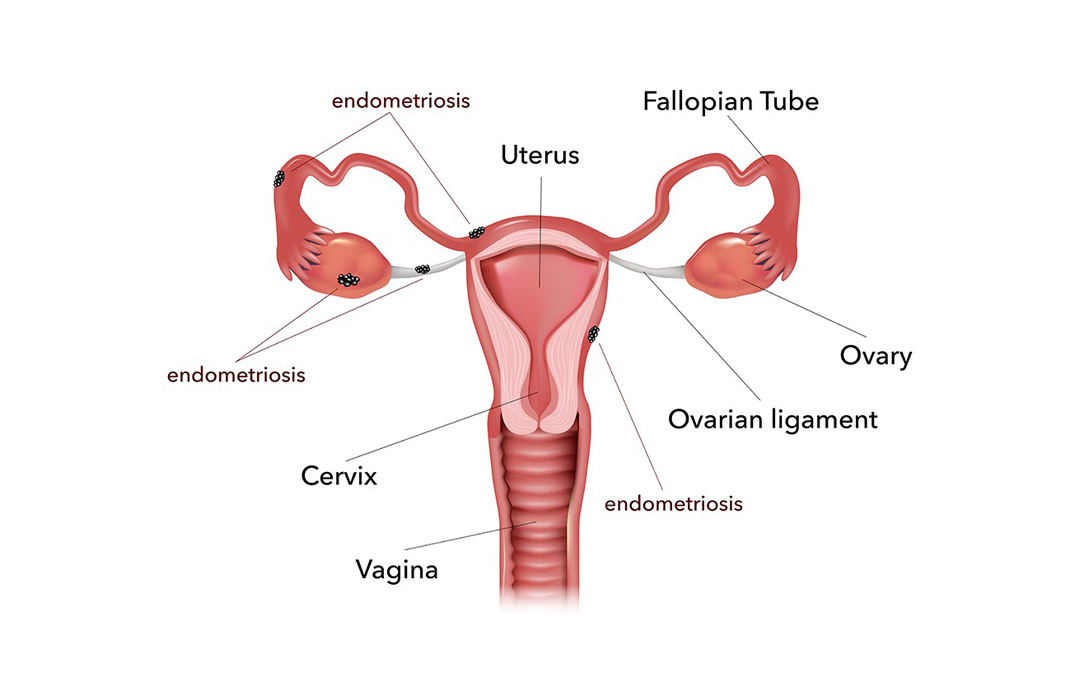 Endometriosis Myovant Sciences Focus Area Endometriosis Imape Tay