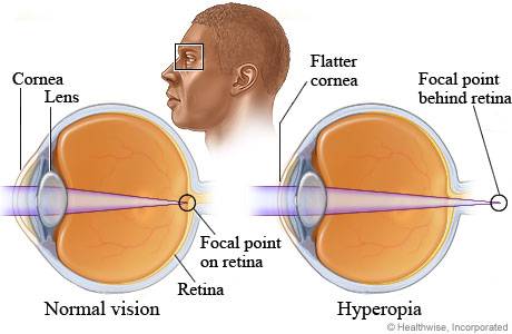 A látás életkorral összefüggő hyperopia helyreállítása