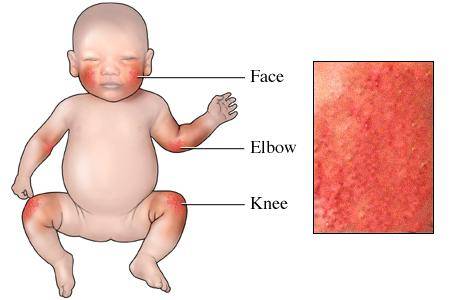 Stock fotó — Allergies, atopic dermatitis on the face of a baby