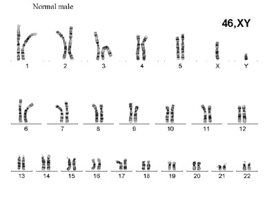 dwarfism karyotype