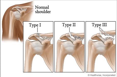 How to Heal an AC Separation - Heiden Orthopedics