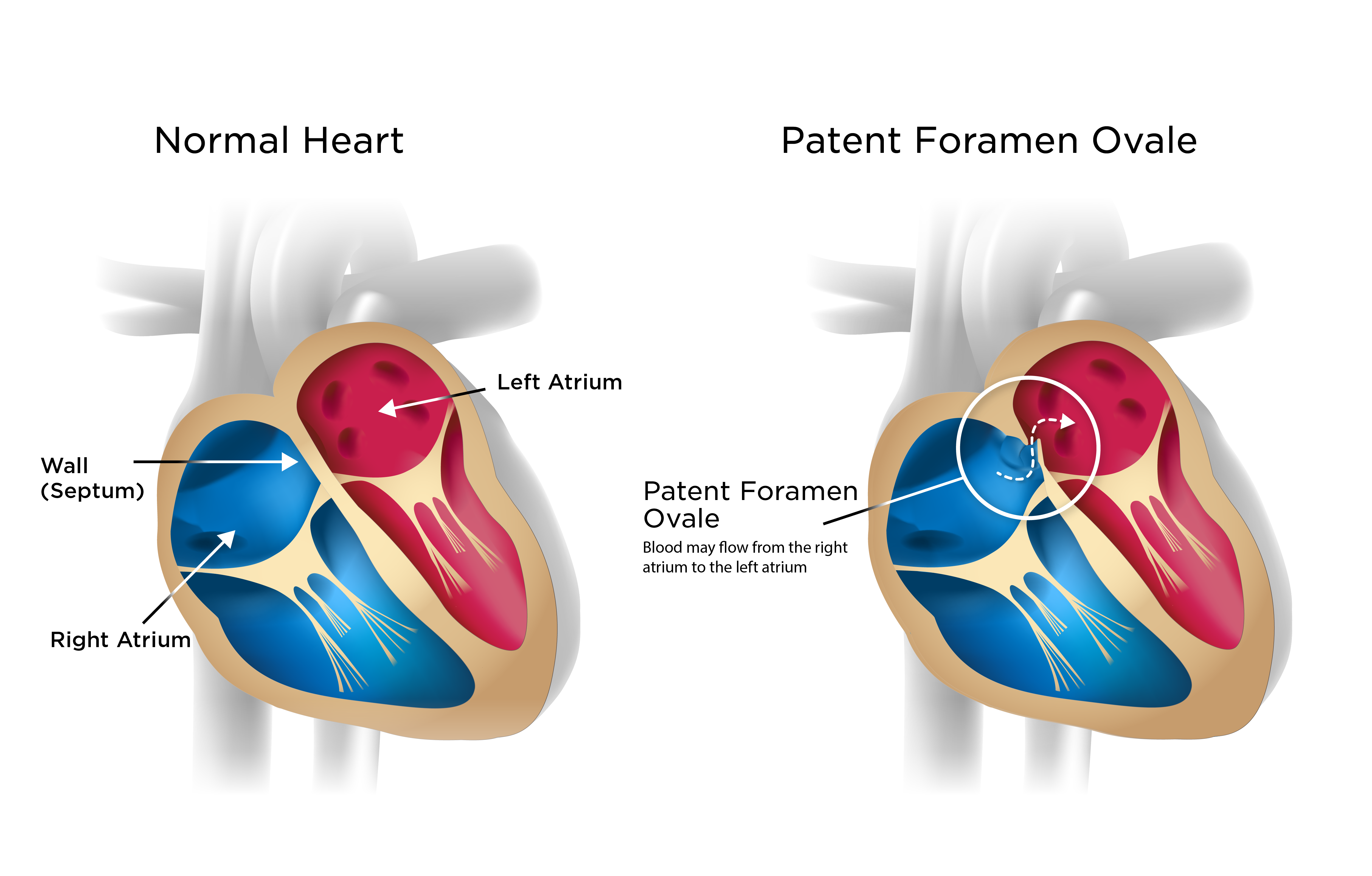 Patent Foramen Ovale | My Doctor Online