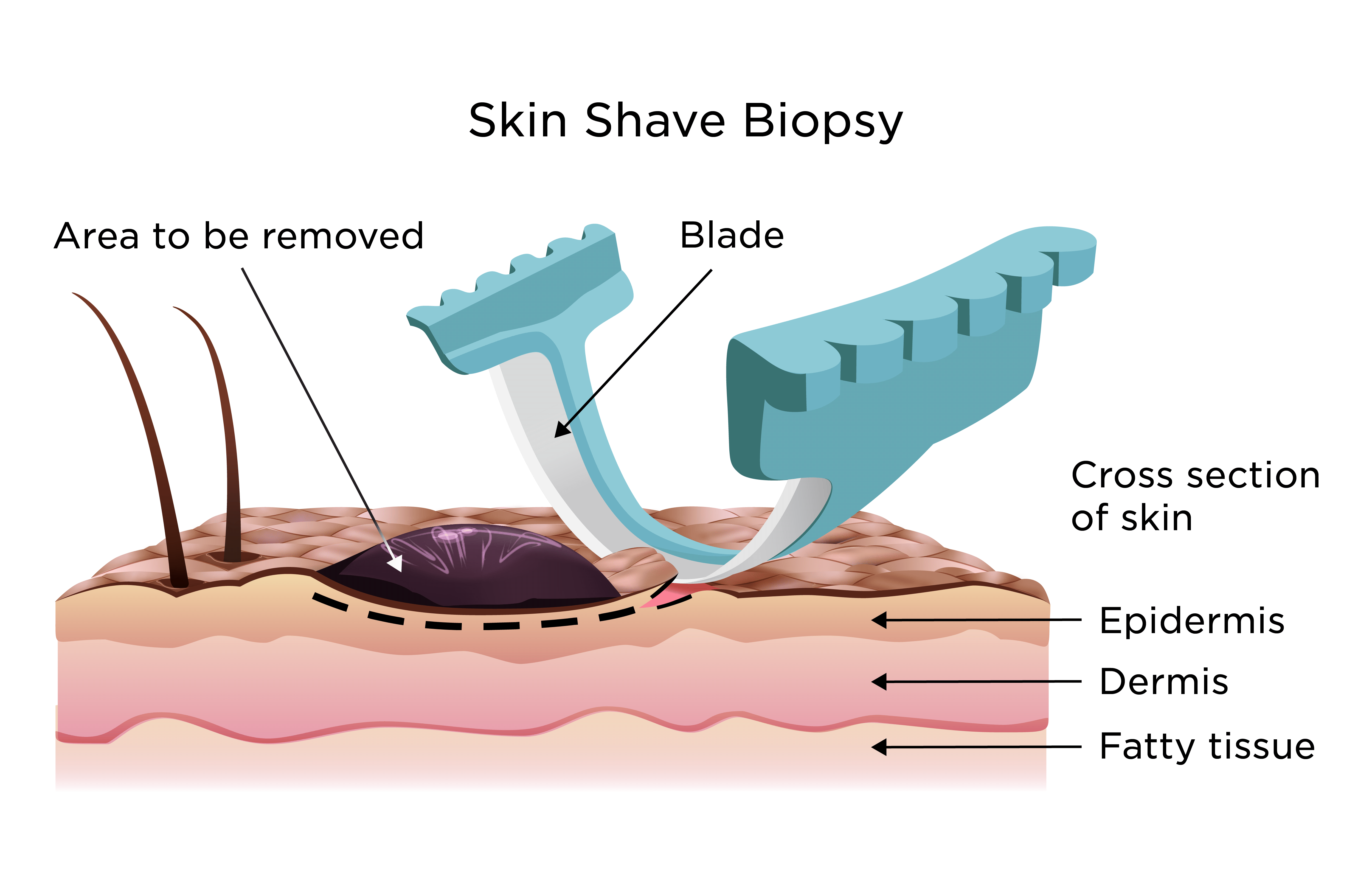 Skin Biopsy Shave Tcm75 2054903 