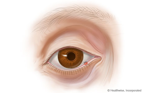 Eye Stye and Chalazion: Symptoms, Causes, Diagnosis & Treatment - Texas Eye  and Cataract