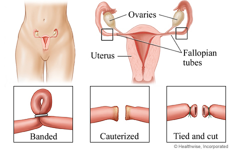 Cesarean Section With Tubal Removal Salpingectomy Or Tubal Ligation My Doctor Online