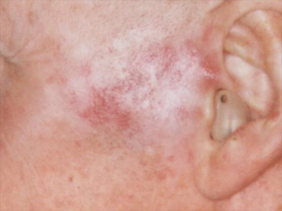 Actinic Keratosis My Doctor Online