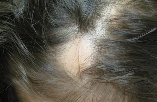 Hair Loss (Alopecia Areata) in Children | My Doctor Online