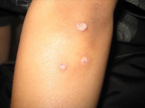 warts on my skin)