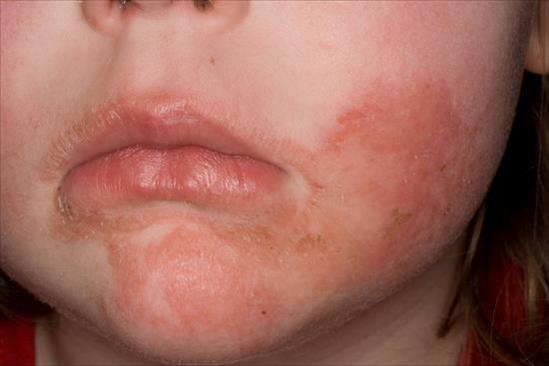 Eczema Atopic Dermatitis My Doctor Online