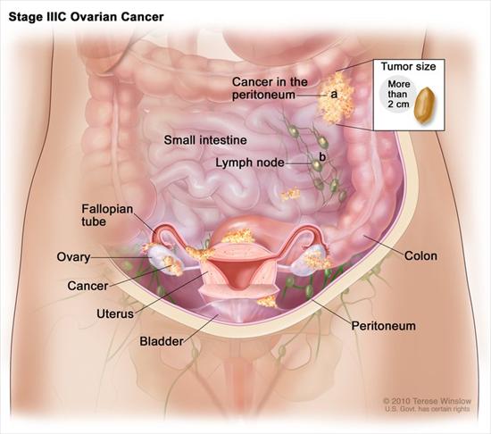 ovarian cancer hysterectomy