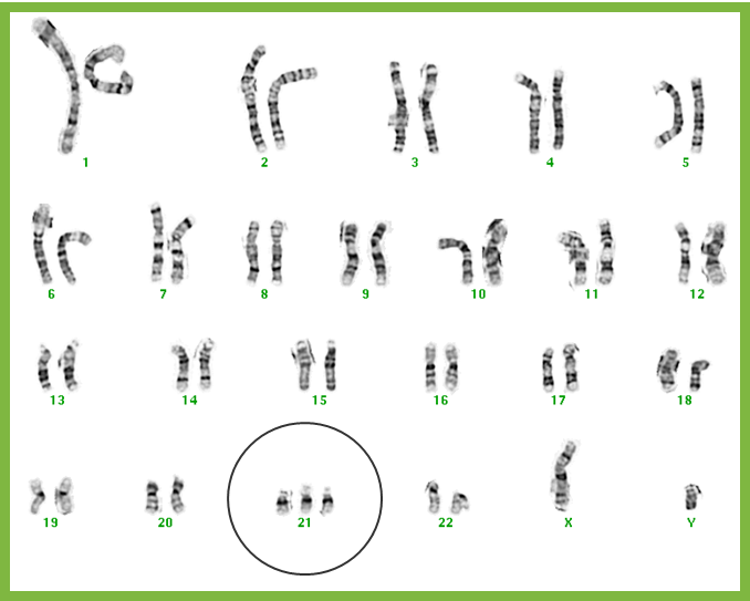 mosaic down syndrome chromosome